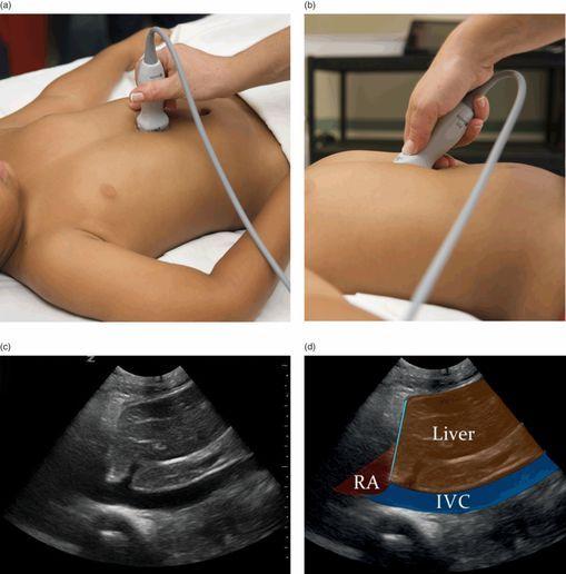 The transducer is oriented perpendicular to the patient s body to achieve an accurate cross-section of the IVC.