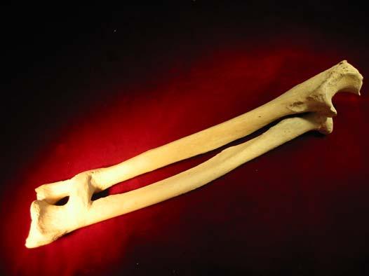 were discarded, and only individuals over the age of 18 years were included to insure skeletal maturity.