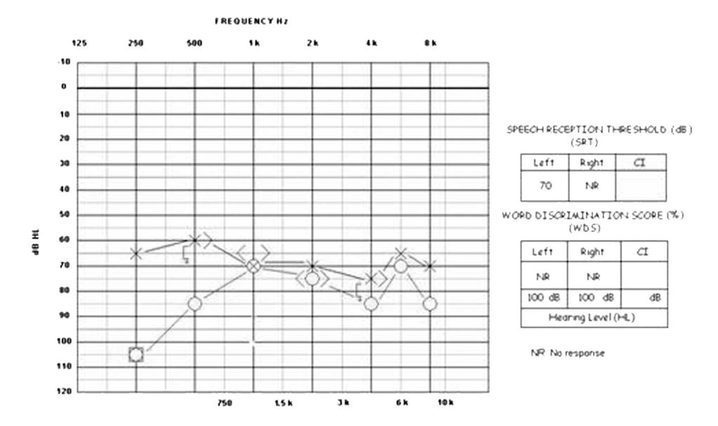 Figure-1: Audiogram results before cochlear implantation. Right-ear and left-ear hearing thresholds before implantation are marked with "O" and "X," respectively.