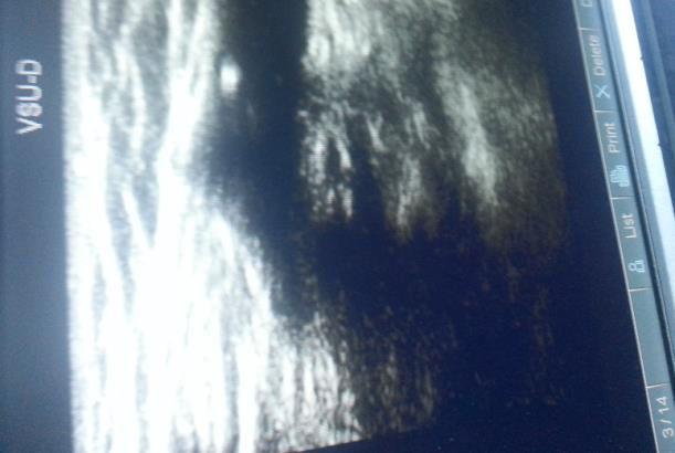Duplex ultrasound of the treated GSV trunk was used for sonographical assessment.