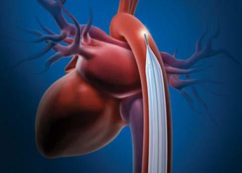 Intra-Aortic Balloon Pump Different sizes depending on height of patient Inflates during diastole leading to diastolic augmentation and