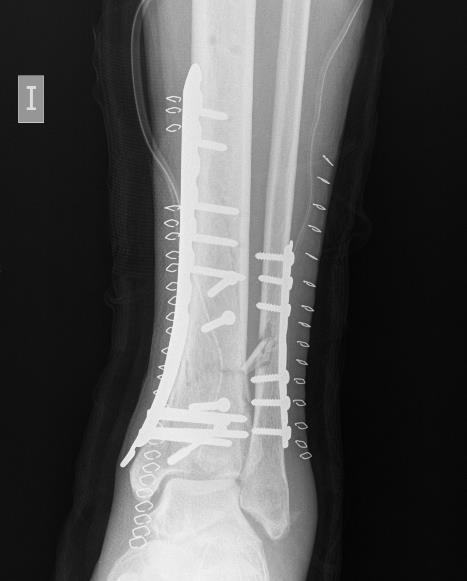 Tibial pilon fractures: which method of treatment? Injury. 2010 Nov;41(11):1183-90 4.Brett D.