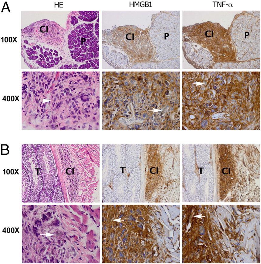 Immunohistochemical analyses show strong HMGB1 and TNF-α staining around areas of asbestos deposits in two