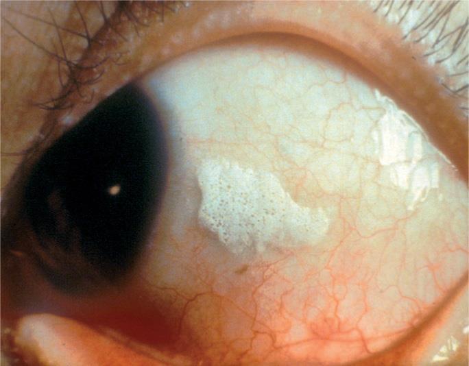Treatment of VAD & Xerophthalmia Xerophthalmia literally means dry eyes.