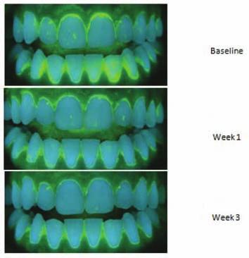 10A Gerlach & Sagel Fig. 4A-C. Overnight plaque at Baseline, and after 1 and 3 weeks use of oral hygiene sequence. entered the research with 17.8% plaque area coverage at baseline (Figs. 4a, 4b, 4c).