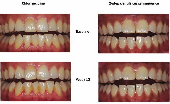 22A Garcia-Godoy et al American Journal of Dentistry, Vol. 31, Special Issue A, July, 2018 Figure.