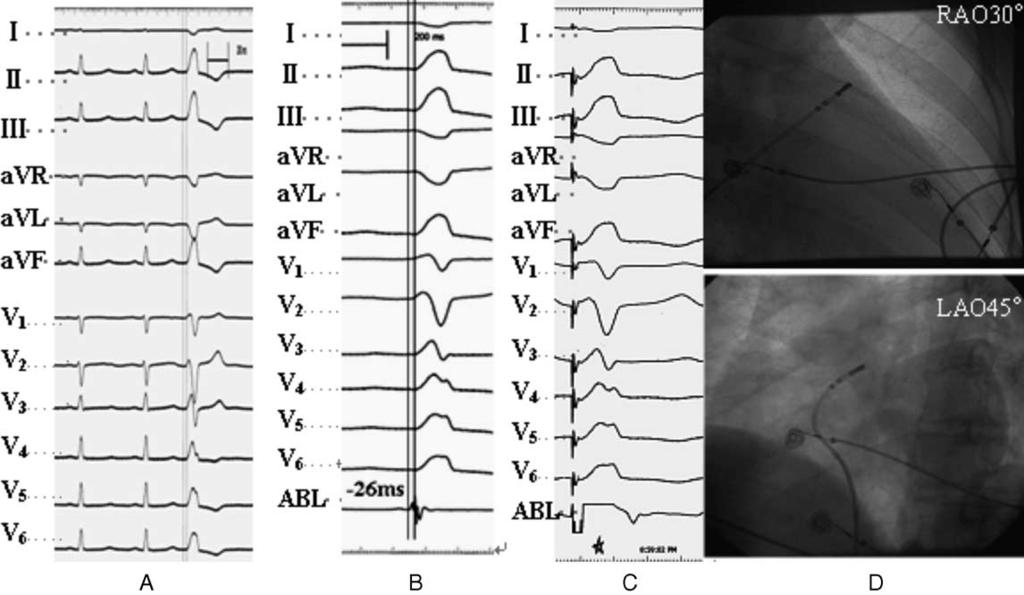 Yue-Chun et al Medicine Volume 94, Number 42, October 2015 FIGURE 1. Recordings obtained at the RVOT ablation site. A, Electrocardiogram characteristic.