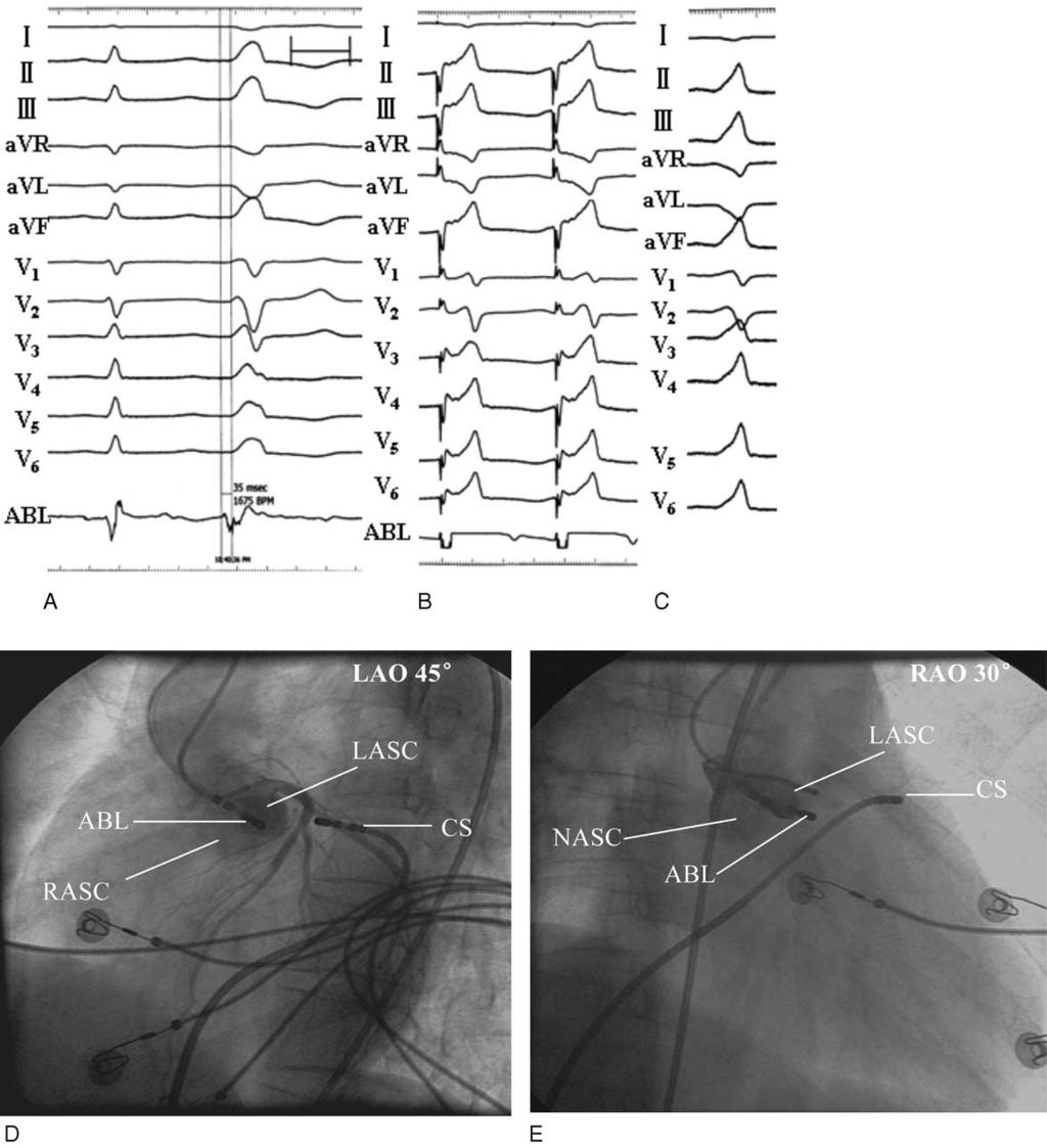 Medicine Volume 94, Number 42, October 2015 Premature Ventricular Complexes QRS Morphology Dynamic Changes FIGURE 3. Recordings obtained at the left ASC ablation site.