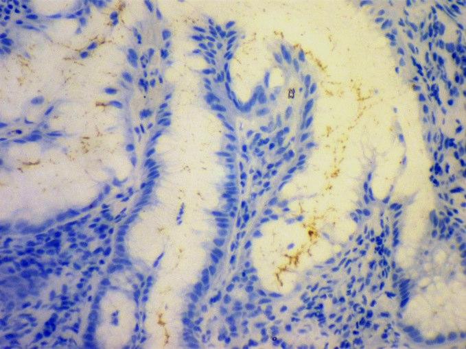 pylori infection in 50 gastric biopsies using Sydney scoring system. Staining method H.