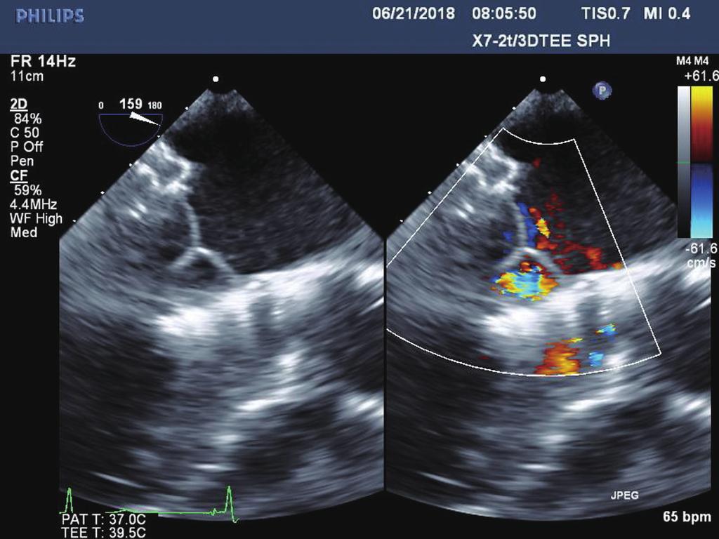 4 Cheung. TIARA TMVR Figure 4 Post implant echocardiogram demonstrated a well seated TIARA valve with no mitral regurgitation or paravalvular leak.