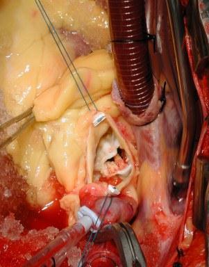 aortic valve JK Ao Perforated non-coronary sinus