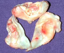 Diseases of the aortic valve Stenosis: Grade Orifice