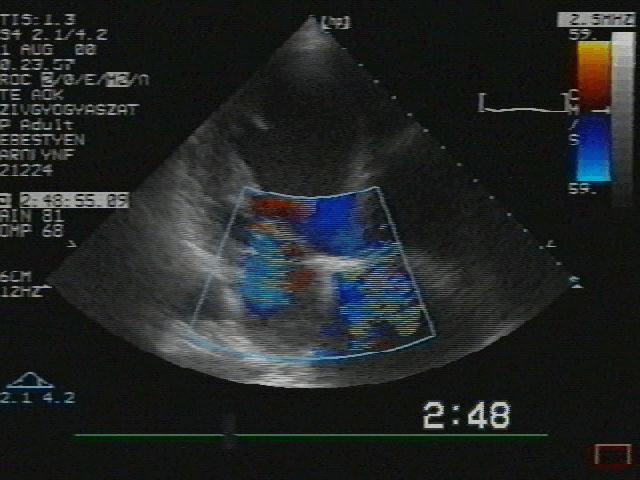 Diseases of the tricuspid valve regurgitation: generally concomitant to mitral insuff., a result of annulus-dilation in CAD IV.