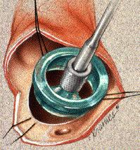 Measuring the annulus Suturing the