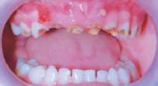 Biological Restorations: An Alternative Esthetic Treatment for Restoration of Severely Mutilated Primary Anterior Teeth Fig.