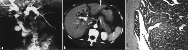 246 W. Jarnagin & C. Winston Figure 1. (a) PTC image showing hilar biliary ductal obstruction with a large filling defect.