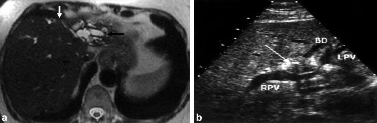 Diagnosis and staging of hilar cholangiocarcinoma 247 Figure 2. (a) Axial MRCP image of a patient with hilar cholangiocarcinoma and left lobe atrophy.