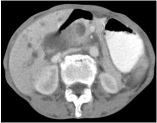 CECT of abdomen showed infiltrating mass in