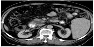 Fig. 4: CASE 4: CECT abdomen image (A),