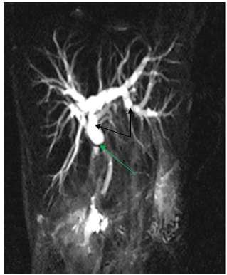 Fig. 8: CASE 8: MRCP revealed dilated IHBR and proximal CBD (black arrows) due to abrupt narrowing in mid segment of CBD (green arrow).