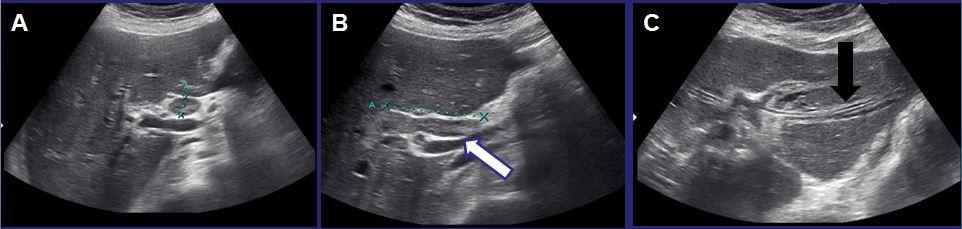 IMAGES Fig. 1: 73 years old woman. US shows a dilated common bile duct with presence of echogenic mass (white arrow in B).
