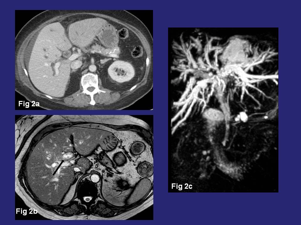 Contrast-enhanced CT (figure 2a) shows dilated common bile duct, with presence of multiple polyps on their wall; and dilated