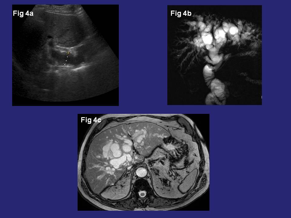 Fig. 4: 78 years old man with diagnosis of IPMN-B. US shows a dilated common bile duct (figure 4a).