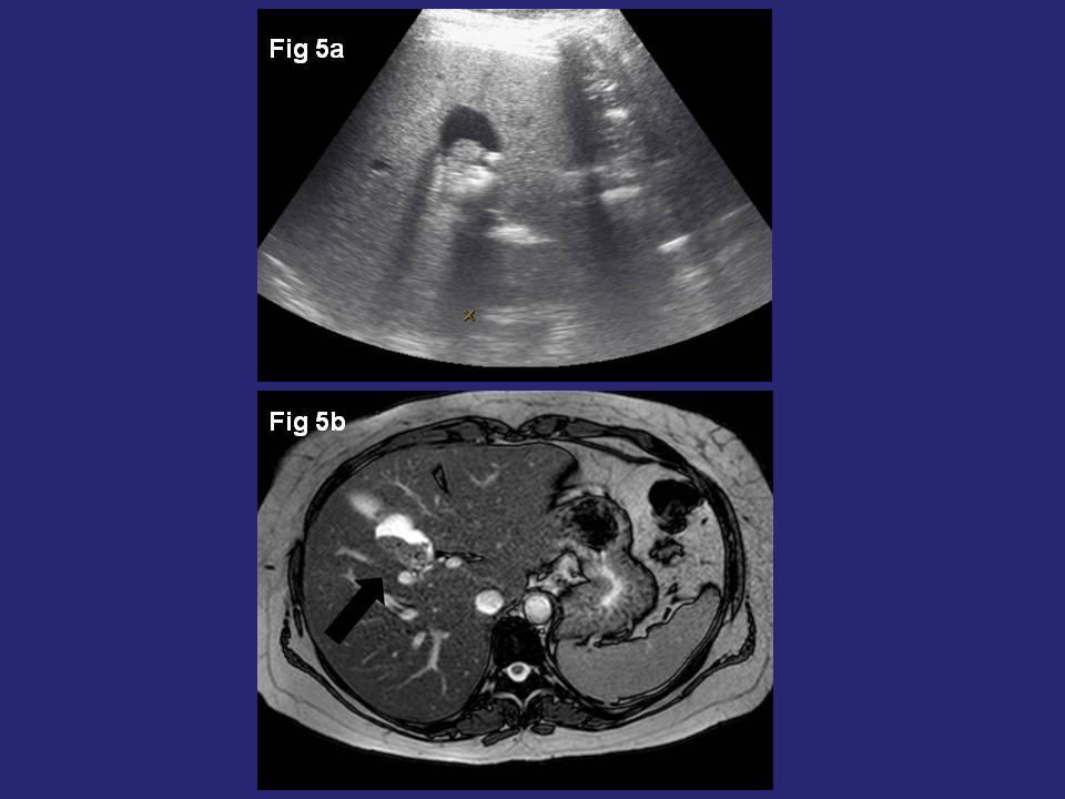 Fig. 5: 36 years old woman. US image (figure 5a) shows a complex-cystic lesion, with presence of an echogenic mass.