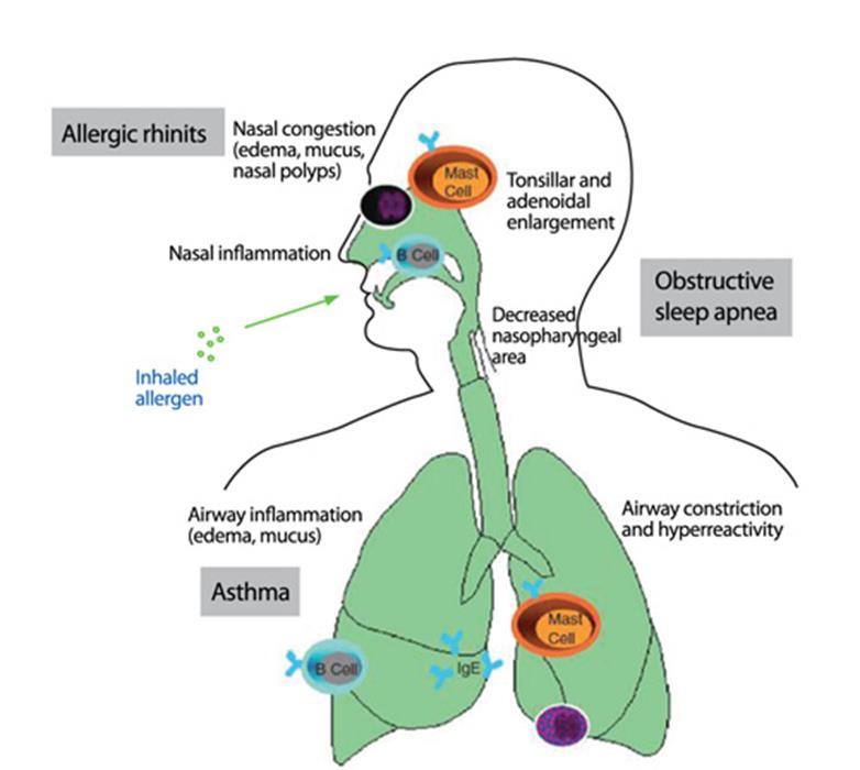 COMORBIDITIES RELATED TO IMMUNE MECHANISMS: 1. Due to the same or related agent (allergen): 1.1. Rhinitis or rhinoconjunctivitis and asthma 1.2. Nasal polyps or chronic sinusitis 1.3.