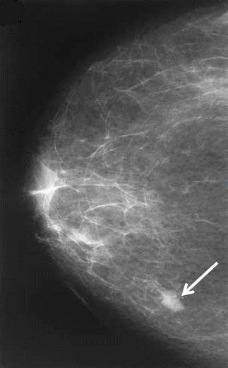Figure1- Dense breast containing a malignant mass [8].