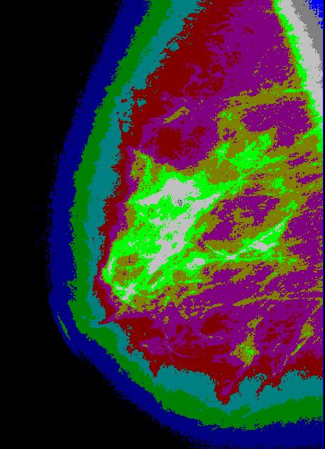 isolating tumor tissue in mammogram images.
