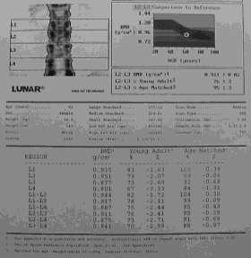 007179 - Macro DEXA CLINICAL HISTORY: REFERENCE FILMS: FINDINGS: FEMUR: The bone mineral density is gm/cm aq. Percentage of young normal mean is %. T-Score is.