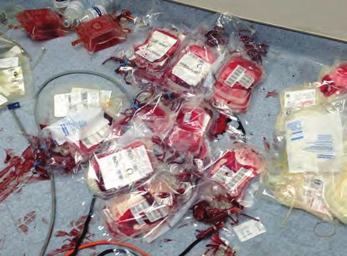 BLOOD REPLACEMENT 55 stored in a warmer, but they can be heated by passage through intravenous fluid warmers. Autotransfusion n FIGURE 3-4 Massive transfusion of blood products in a trauma patient.