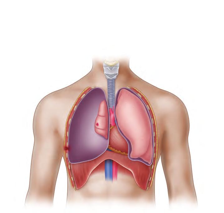 PRIMARY SURVEY: LIFE-THREATENING INJURIES 67 Collapsed lung Pneumothorax Sucking chest wound n FIGURE 4-3 Open Pneumothorax.