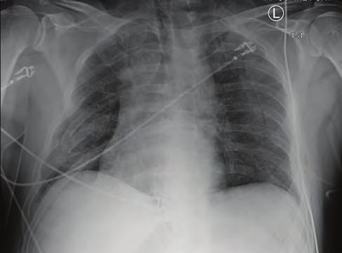 74 CHAPTER 4 n Thoracic Trauma A B n FIGURE 4-9 Flail Chest. The presence of a flail chest segment results in disruption of normal chest wall movement. A. Flail chest from multiple rib fractures. B. Flail chest from costochondral separation.