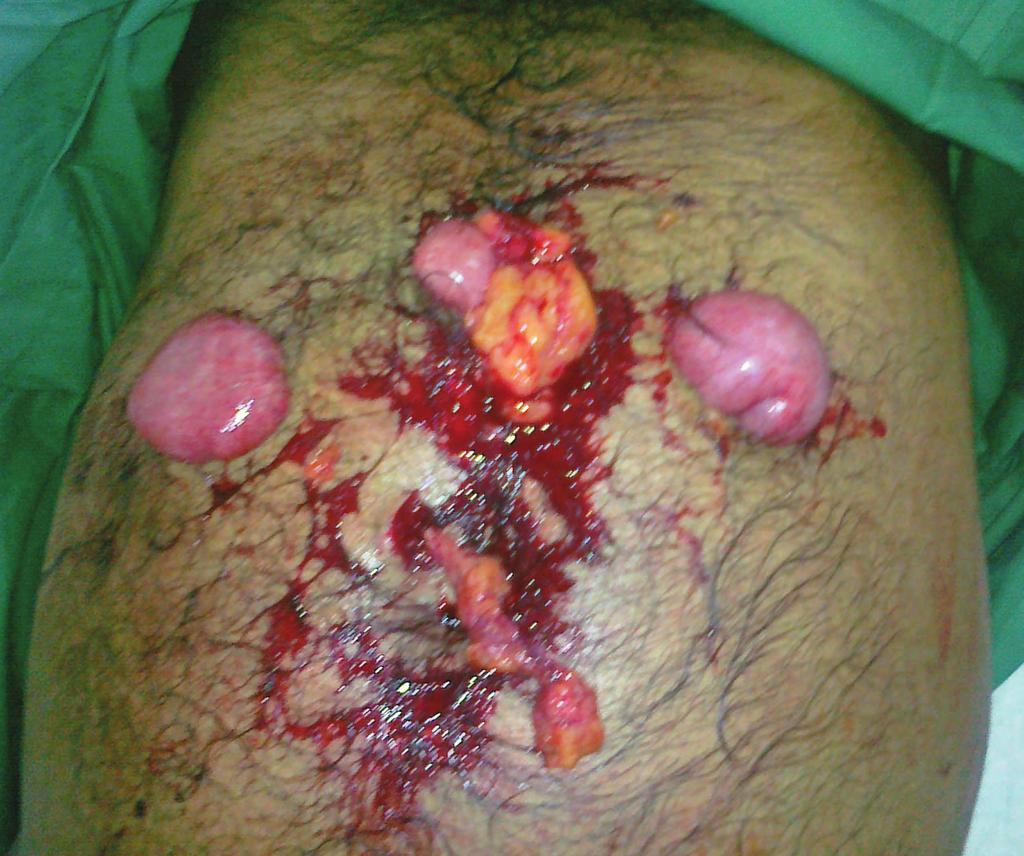 ABDOMINAL AND 5 PELVIC TRAUMA When uncontrolled or unrecognized, blood