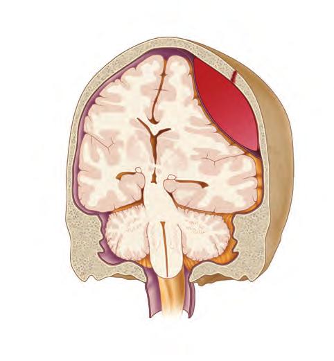 When the normal intracranial volume is exceeded, ICP rises. Venous blood and CSF can be compressed out of the container, providing a degree of pressure buffering (n FIGURE 6-5 and n FIGURE 6-6).