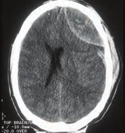 EVIDENCE-BASED TREATMENT GUIDELINES 111 an acute subdural hematoma is typically much more severe than that associated with epidural hematomas due to the presence of concomitant parenchymal injury.