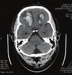Right intraparenchymal hemorrhage with right to left midline shift and associated biventricular hemorrhages. Epidural Hematomas Epidural hematomas are relatively uncommon, occurring in about 0.