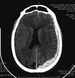 These hematomas typically become biconvex or lenticular in shape as they push the adherent dura away from the inner table of the skull.