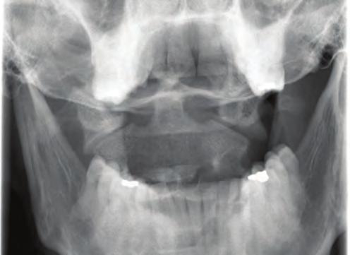 SPECIFIC TYPES OF SPINAL INJURIES 137 n FIGURE 7-4 Jefferson Fracture. Open-mouth view radiograph showing a Jefferson fracture.