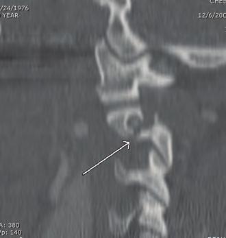 They are caused by flexion about an axis anterior to the vertebral column and are most frequently seen following motor vehicle crashes in which the patient was restrained by only an improperly placed
