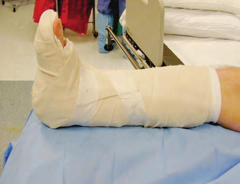 164 CHAPTER 8 n Musculoskeletal Trauma A B n FIGURE 8-10 Splinting of an ankle fracture. Note extensive use of padding with posterior and sugartong splints. A. Posterior and sugartong plaster splints being secured in place with an elastic bandage wrap.