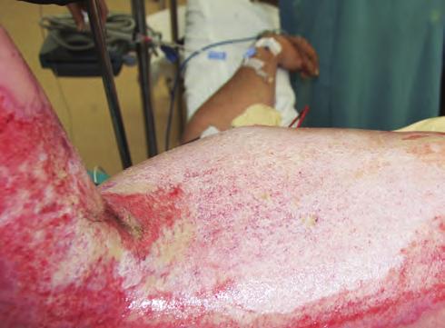 PRIMARY SURVEY AND RESUSCITATION OF PATIENTS WITH BURNS 173 resuscitation is required to replace the ongoing losses from capillary leak due to inflammation.