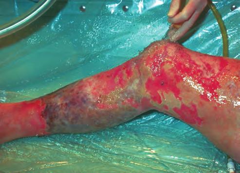 UNIQUE BURN INJURIES 179 consideration, including chemical, electrical, and tar burns, as well as burn patterns that indicate abuse.