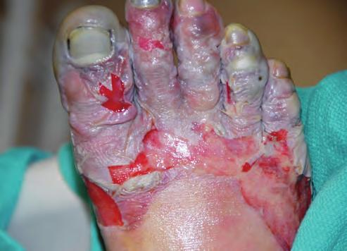 182 CHAPTER 9 n Thermal Injuries local infection, cellulitis, lymphangitis, and gangrene can occur. Proper attention to foot hygiene can prevent the occurrence of most such complications.