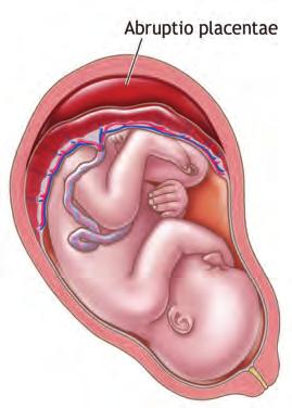 234 CHAPTER 12 n Trauma in Pregnancy and Intimate Partner Violence A B C n FIGURE 12-6 Abruptio placentae. A. In abruptio placentae, the placenta detaches from the uterus. B. Axial and C.