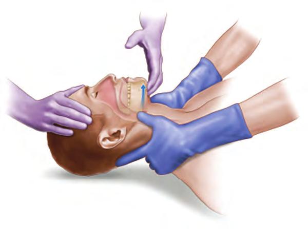 ) The first priority of airway management is to ensure continued oxygenation while restricting cervical spinal motion. Clinicians accomplish this task initially by positioning (i.e., chin-lift or jaw-thrust maneuver) and by using preliminary airway techniques (i.