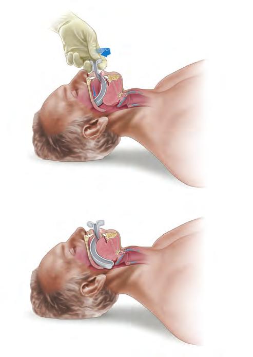 AIRWAY MANAGEMENT 31 Oropharyngeal Airway Oral airways are inserted into the mouth behind the tongue.