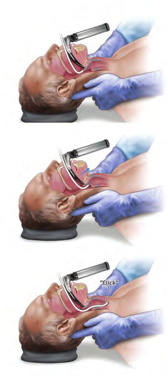 The GEB is lubricated and placed in back of the epiglottis with the tip angled toward the front of the neck. B.